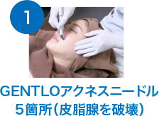 GENTLOアクネスニードル５箇所（皮脂腺を破壊）