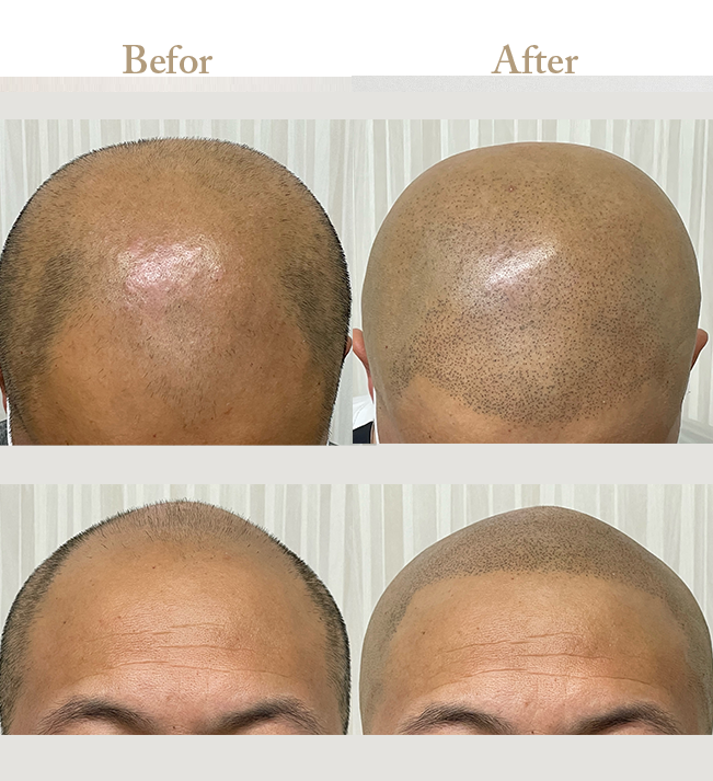 ニキビの治療Befor_Afterその2