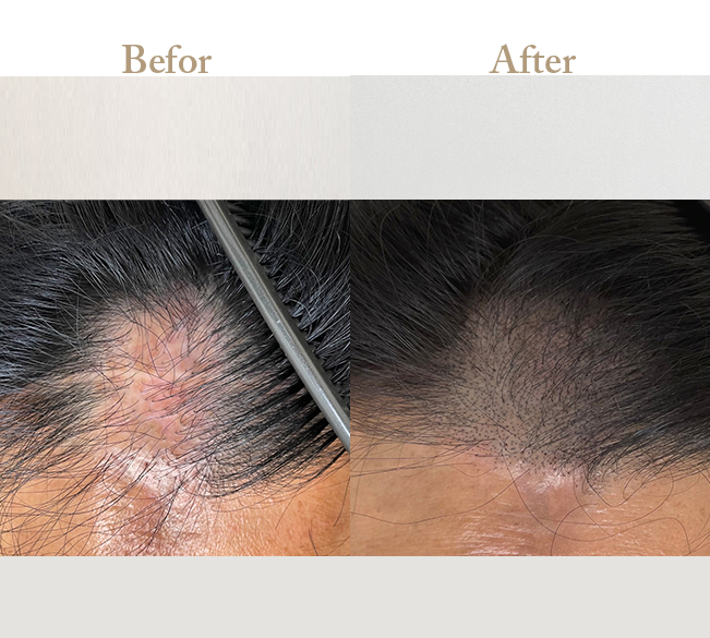 ニキビの治療Befor_Afterその3