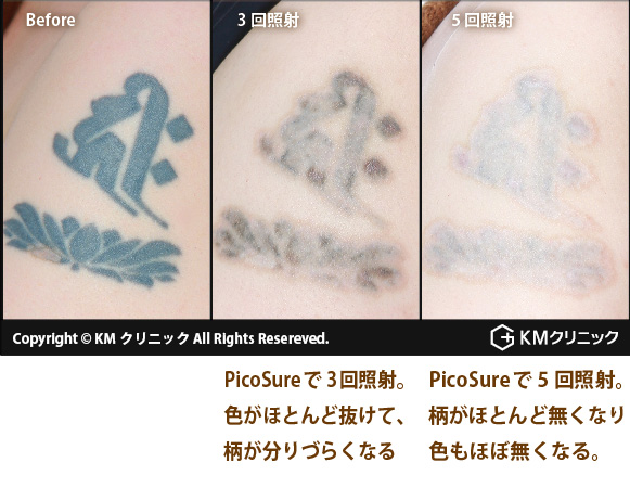 PicoSure施術を追加(1回)により色素は殆ど除去された。