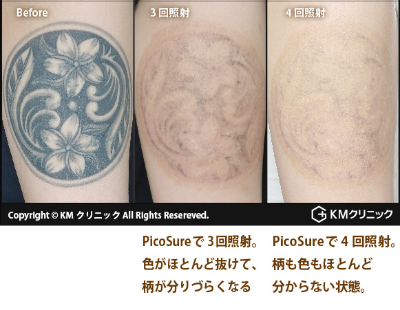 ピコシュア タトゥー 刺青除去 美容皮膚科 美容外科のkm新宿クリニック