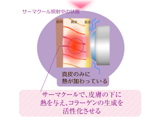 熱を与えている状態、皮下組織に直接熱を与えるので表皮にダメージはありません。