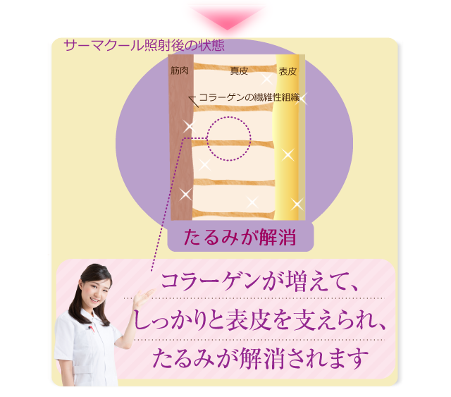 たるみの無い状態。コラーゲンはしっかりと増えて表皮を支えることができ、たるみが解消されます。
