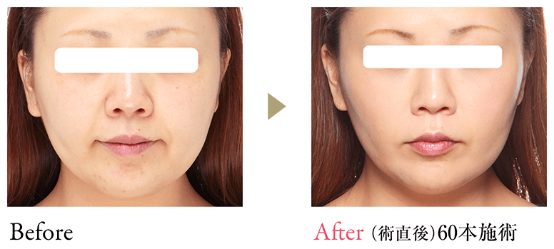 Before After (術直後 60本施術)