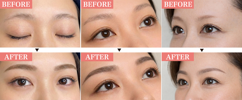 アートメイク症例写真