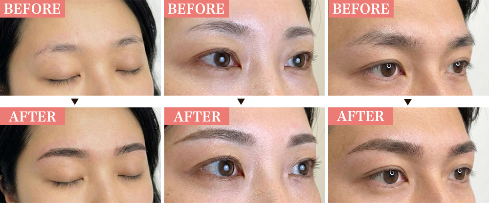 アートメイク症例写真