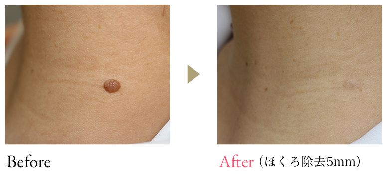 Before After(ほくろ除去5mm)