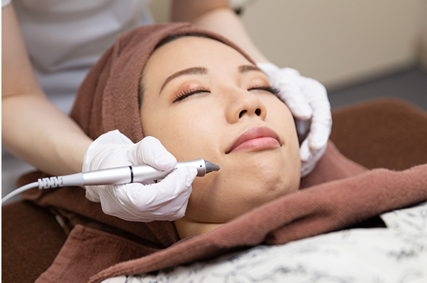 GENTLOアクネスニードル5か所の施術の様子