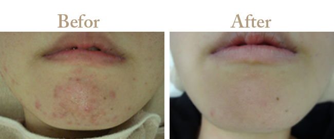 ニキビの治療Befor_Afterその2