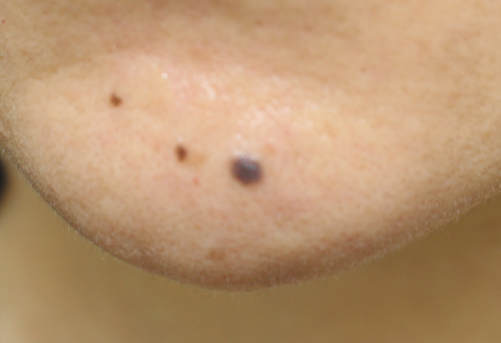 トッテモーレ ほくろ いぼ除去 ほくろ除去は美容皮膚科のkm新宿クリニックへ
